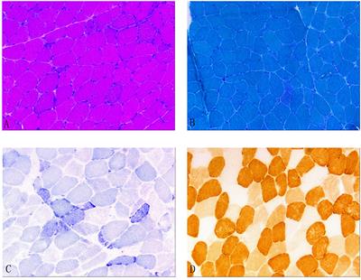 Have one's view of the important overshadowed by the trivial: chronic progressive external ophthalmoplegia combined with unilateral facial nerve injury: a case report and literature review